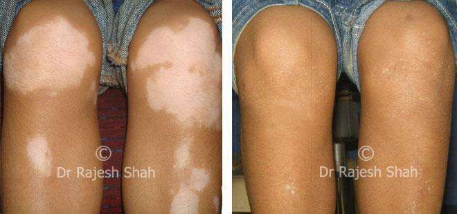 Vitiligo Before and After Case Photo