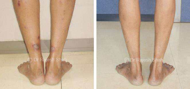 Psoriasis Before and After Case Photo