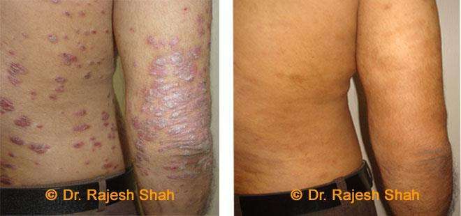Psoriasis Before and After Case Photo