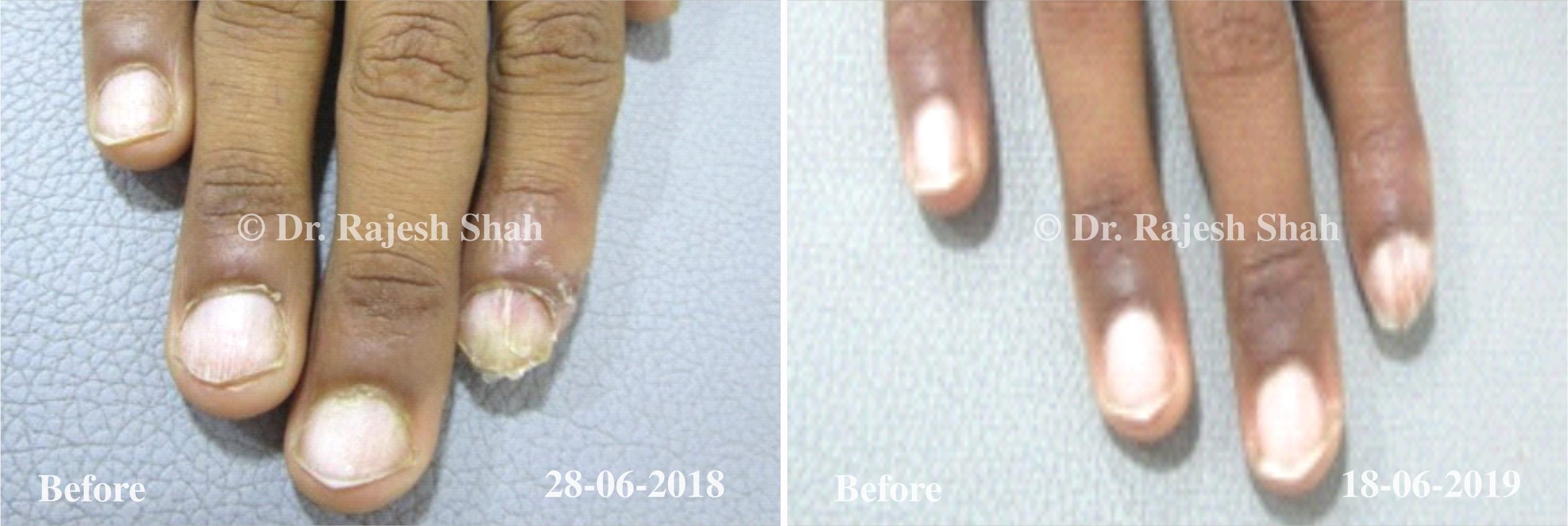 Eczema Before and After Case Photo