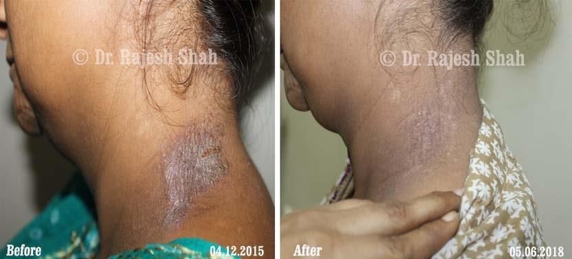 Prurigo Nodularis Before and After Case Photo