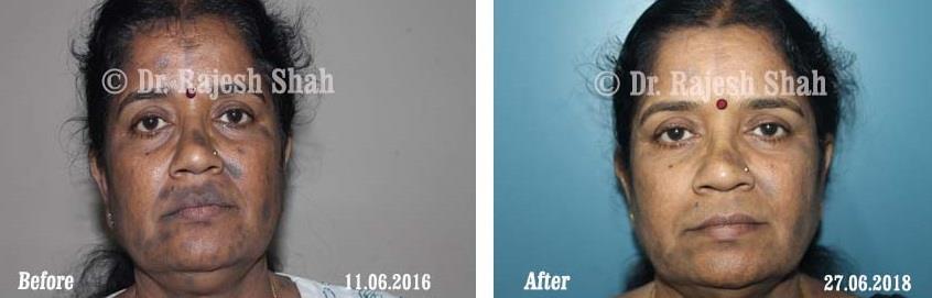 Lichen Planus Pigmentosa Before and After Case Photo