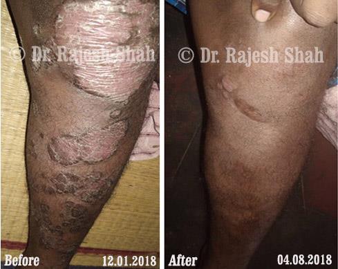 Psoriasis Before and After Case Photo
