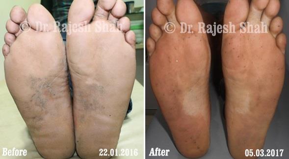 Psoriasis Before and After Case Photo