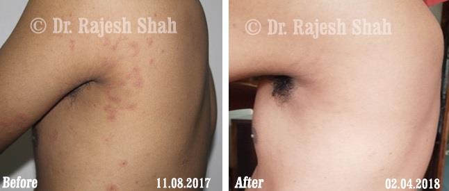 Lichen Planus Before and After Case Photo