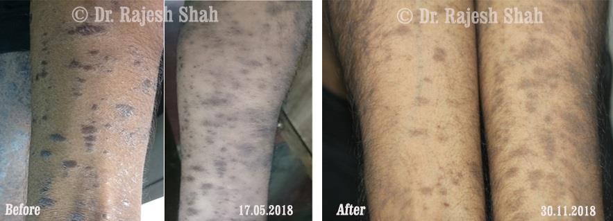 Lichen Planus Before and After Case Photo