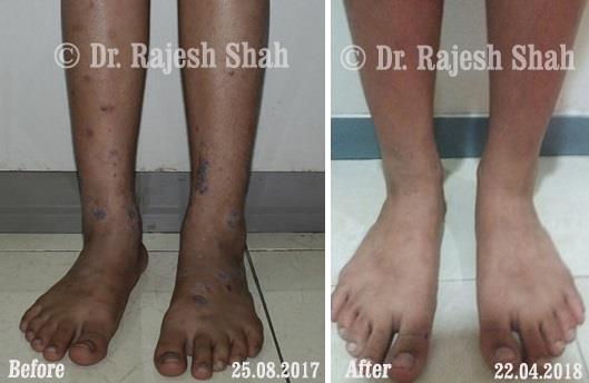 Lichen Planus Before and After Case Photo