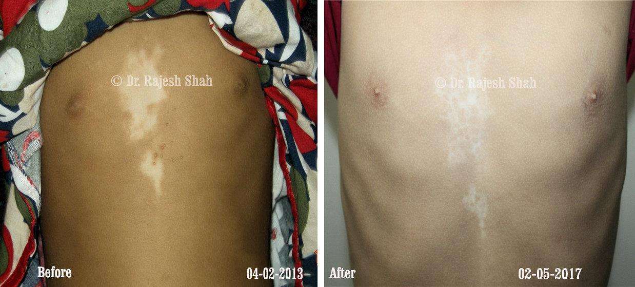 Vitiligo Before and After Case Photo
