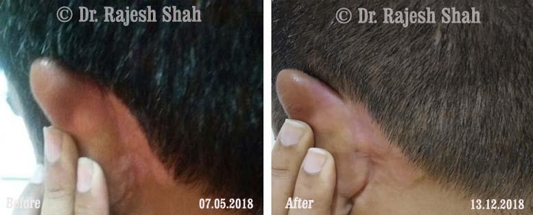 Psoriasis Before and After Case Photo