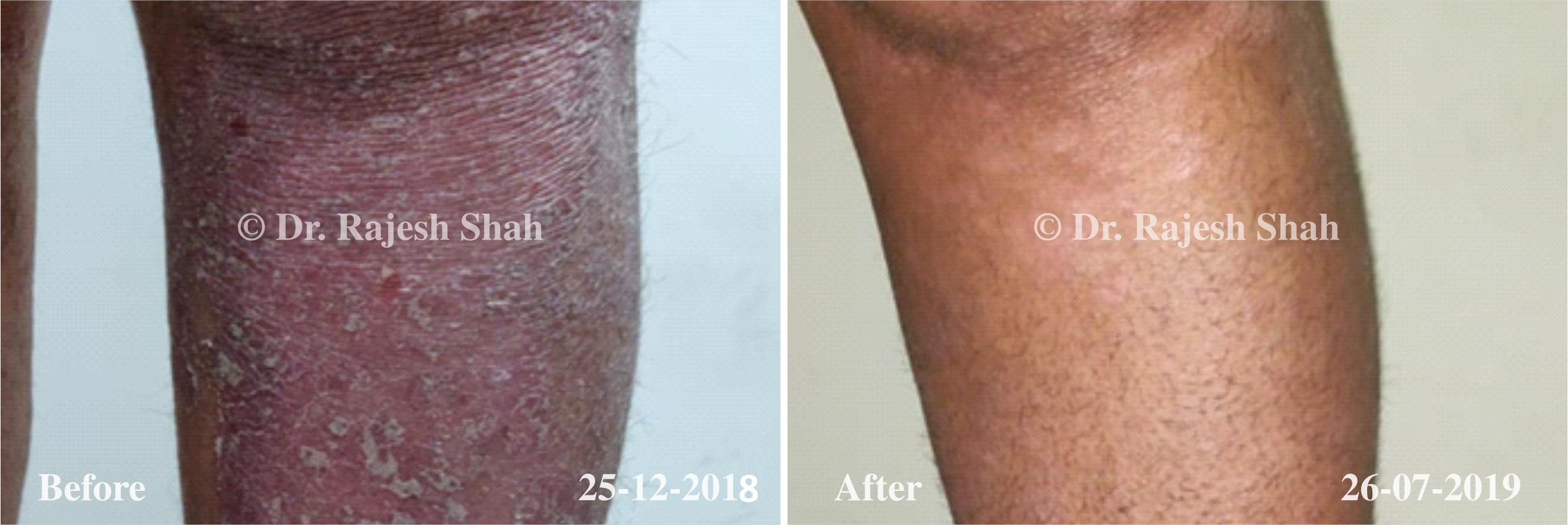 Psoriasis Before and After Case Photo