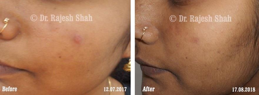 Acne Before and After Case Photo