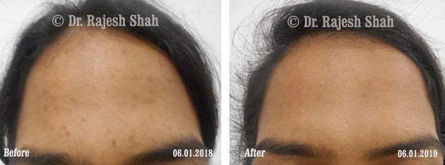 Acne Before and After Case Photo