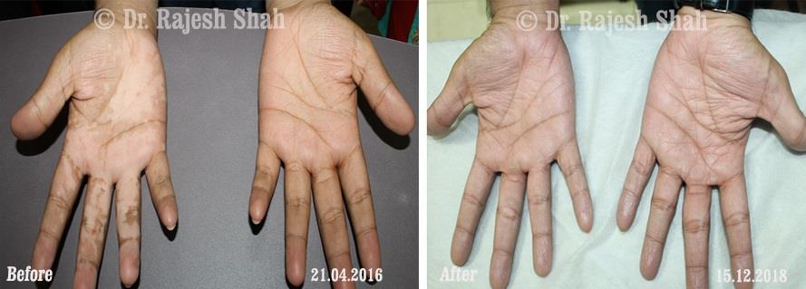 Vitiligo Before and After Case Photo