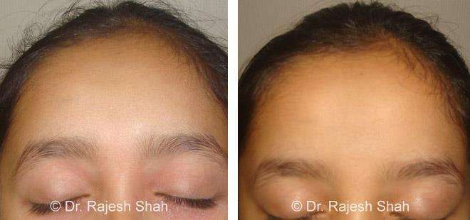 Eczema Before and After Case Photo