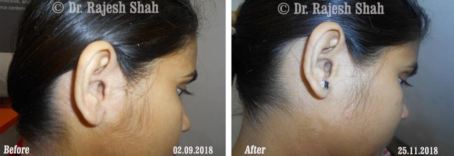 Psoriasis Before and After Case Photo