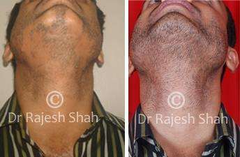 Alopecia Areata Before and After Case Photo