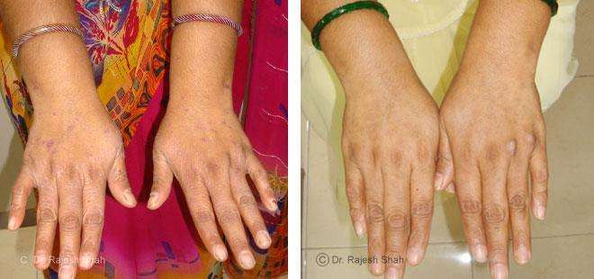 Lichen Planus Before and After Case Photo