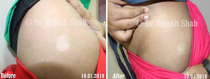Vitiligo Before and After Case Photo
