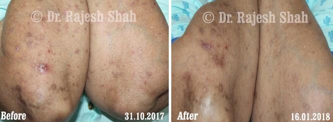 Lichen Planus Before and After Case Photo