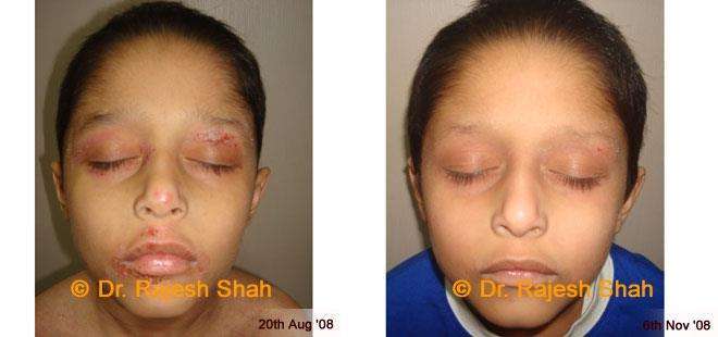 Eczema Before and After Case Photo