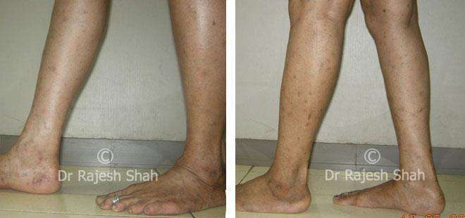 Lichen Planus Before and After Case Photo