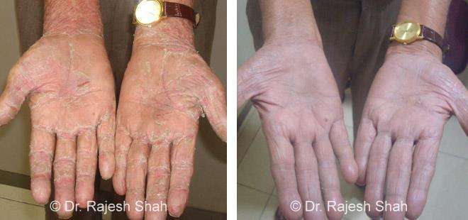 Psoriasis Before and After Case Photo