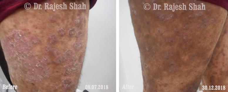 Psoriasis Before and After Case Photo