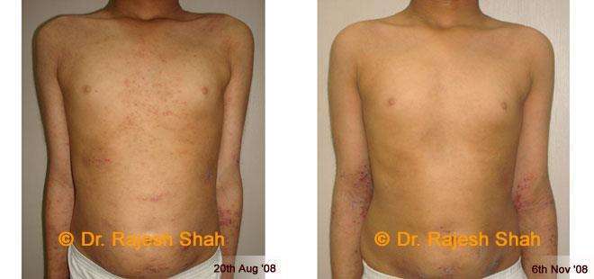 Eczema Before and After Case Photo