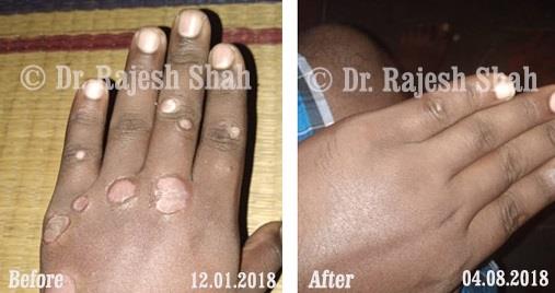 Psoriasis Before and After Case Photo