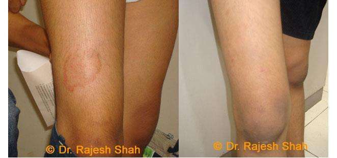 Psoriasis Before and After Case Photo