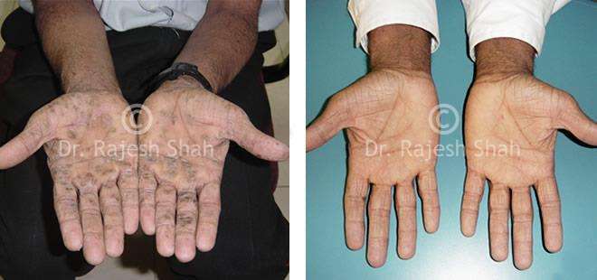 Psoriasis Before and After Case Photo