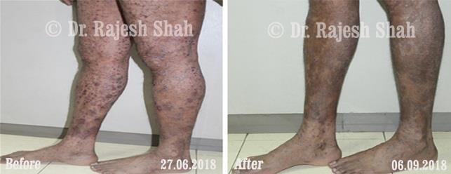 Psoriasis Before and After Case Photo