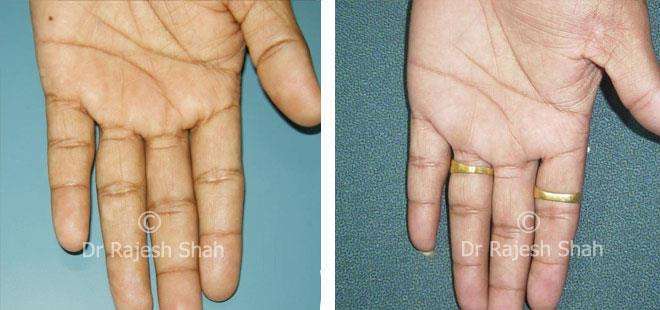 Vitiligo Before and After Case Photo