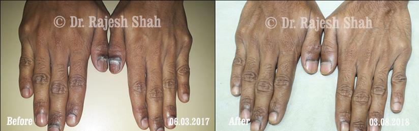 Lichen Planus Before and After Case Photo