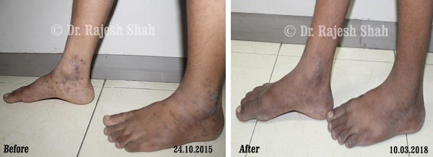 Lichen Planus Before and After Case Photo