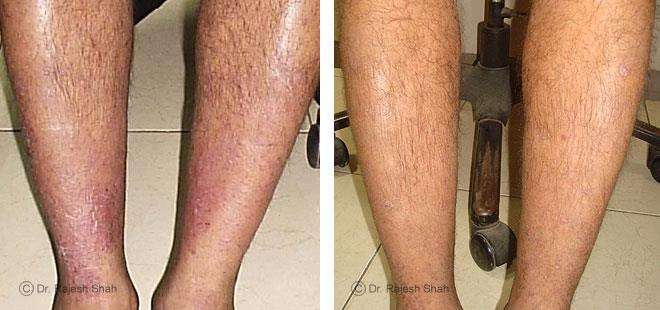 Psoriasis Before and After Case Photo