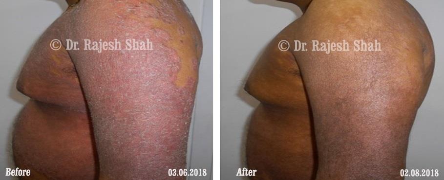 Psoriasis Before and After Case Photo