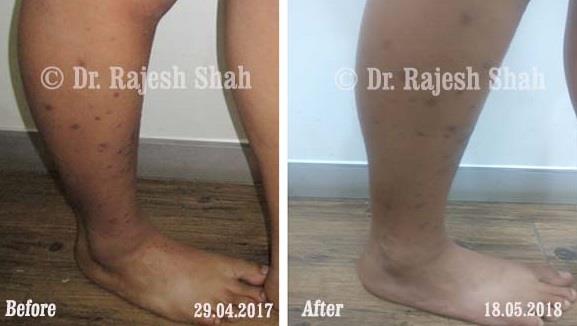 Lichen Planus Before and After Case Photo