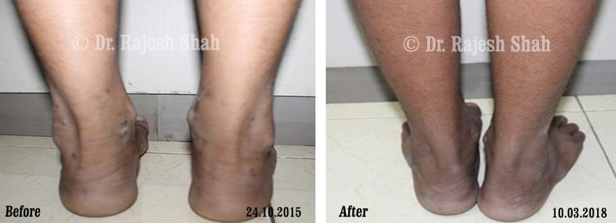 Lichen Planus Before and After Case Photo