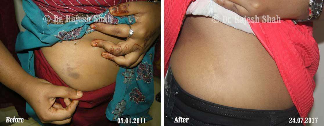 Lichen Planus Before and After Case Photo