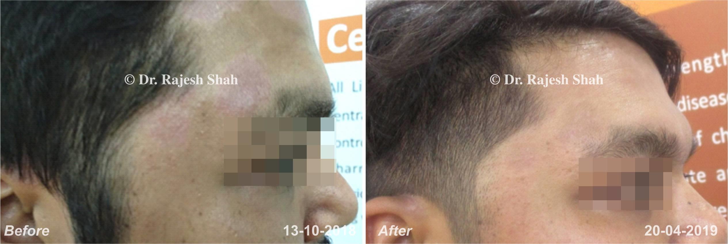 Psoriasis Before and After Case Photo