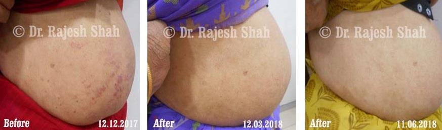 Psoriasis Before and After Case Photo