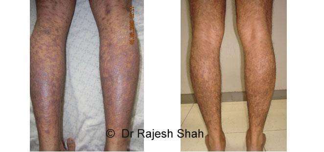 Lichen Planus Before and After Case Photo