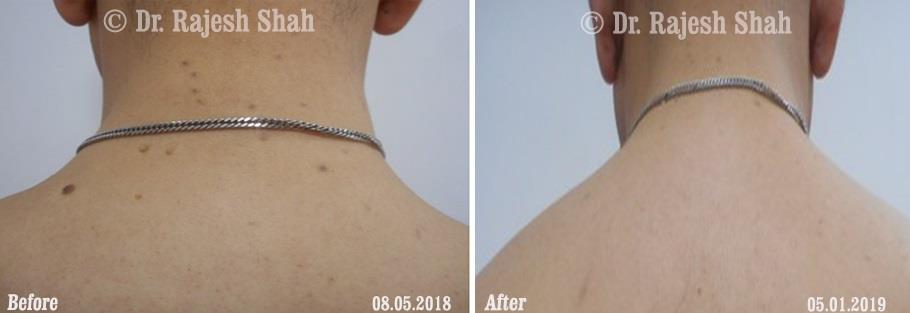 Lichen Planus Before and After Case Photo