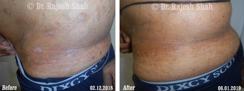 Psoriasis Before and After Case Photo