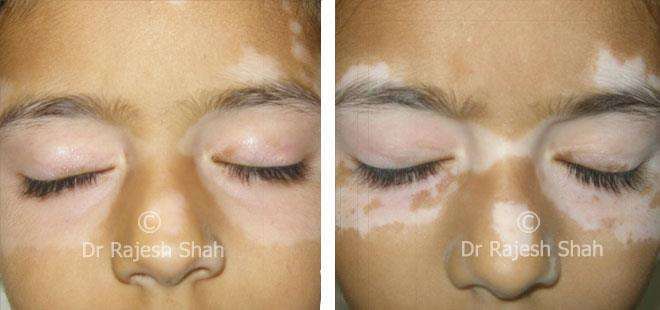 Vitiligo Before and After Case Photo