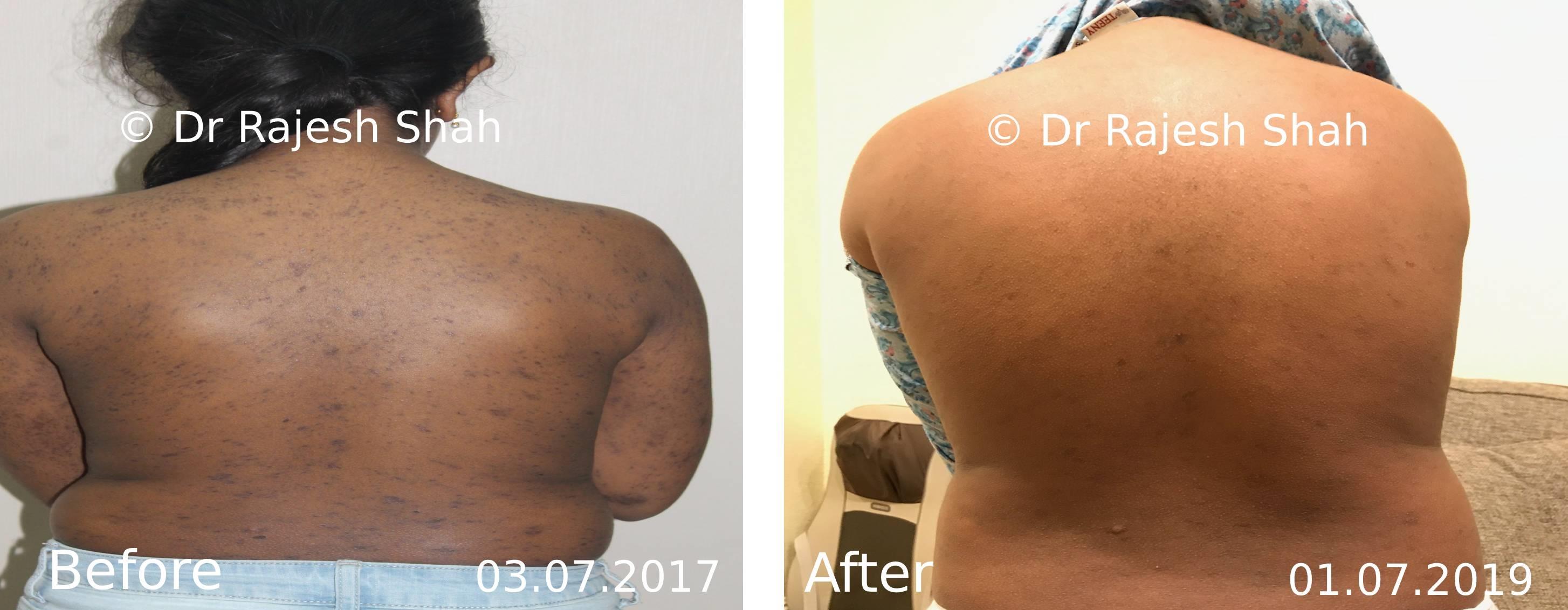 Lichen Planus Before and After Case Photo