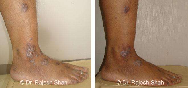 Lichen Planus Before and After Case Photo