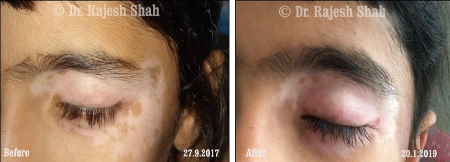 Vitiligo Before and After Case Photo