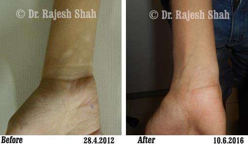 Vitiligo Before and After Case Photo